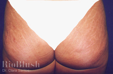 Stretch marks before